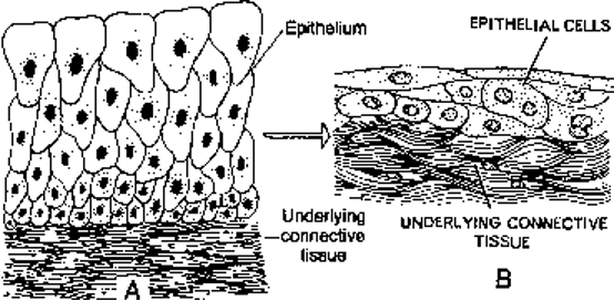 Transitional epithelium in wall of nondistended and distended urinary bladder