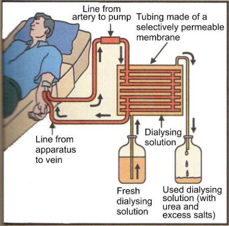 kidney Dialysis